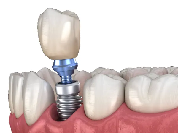 Procedimento de implante dentário de alta tecnologia e precisão