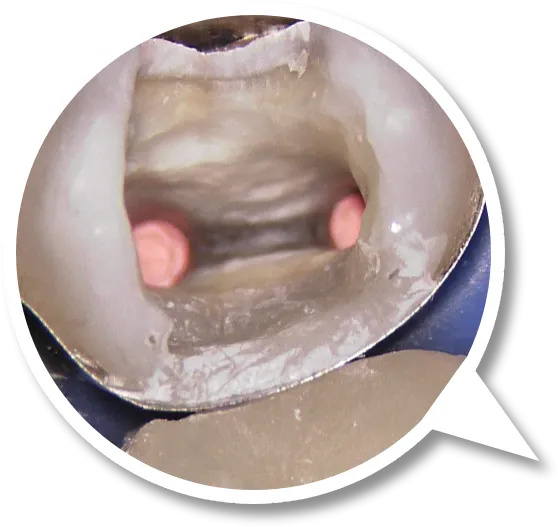 Detalhe de microscopia operatória odontológica de alta magnificação
