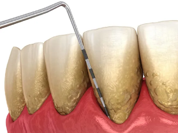 Tratamento de periodontia e saúde das gengivas