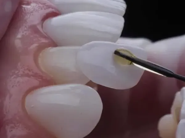 Prótese dentária sob medida para reabilitação oral e função mastigatória